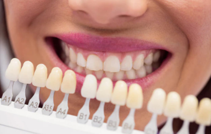 Los Mejores Métodos de Blanqueamiento Dental